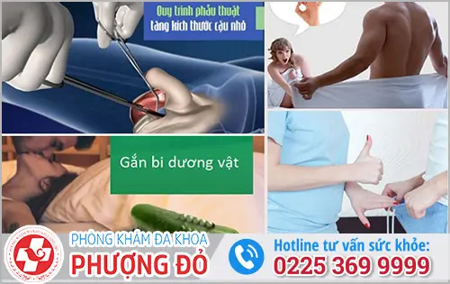 Tiểu phẫu gắn bi để làm to dương vật hiệu quả