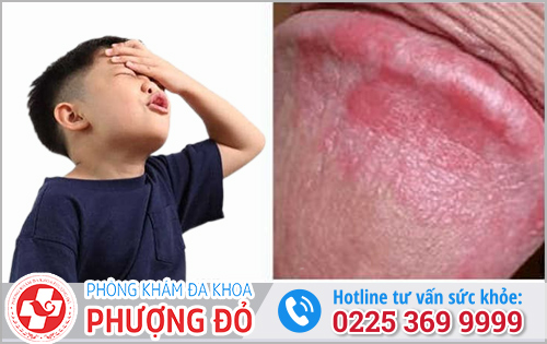 Hậu quả khi bị viêm bao quy đầu lâu ngày
